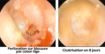 perforations du tympan
